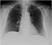 Abb. 4: Cor/Pulmo-Rntgen