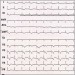 Abb. 5: EKG