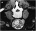 Abb. 2: Abdominelles Aortenaneurysma - CT