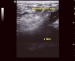Abb. 2: Endovenser Laser