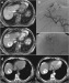 Abb. 2: HCC - MRT