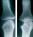 Abb. 1: Rheumatoide Arthritis - Knochenerosion