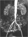 Abb. 1: Aortenbifurkationsstenose - Stenose der Arteria iliaca communis