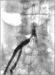 Abb. 2: Aortenbifurkationsstenose