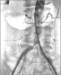 Abb. 3: Aortenbifurkationsstenose