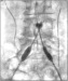 Abb. 4: Kissing-Stenting