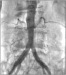 Abb. 5: Abschluangiographie