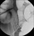 Abb. 1a: Enteroklysma