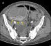 Abb. 2: CT-Enteroklysma