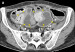 Abb. 3: CT-Enteroklysma