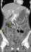 Abb. 3c: CT-Enteroklysma