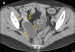 Abb. 4: Morbus Crohn-Rezidiv