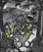 Aktuelles Bild - Abb. 6: MR-Enteroklysma