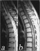 Abb. 1a-b: Neuromyelitis optica