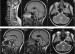 Abb. 2: Neuromyelitis optica