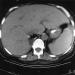 Abb. 2: Emphysematse Pyelonephritis