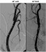 Abb. 4: Arteria carotis interna - Stentgraftimplantation