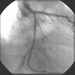 Aktuelles Bild - Abb. 4: Angiogramm - PCI