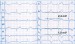 Abb. 1: Hypertrophie - EKG