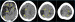 Abb. 1c: Multi-Infarkt-Demenz