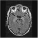 Abb. 1: Nichtneoplastische limbische Enzephalitis