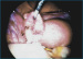 Abb. 1: Ectopic pregnancy
