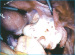 Abb. 2: Contralateral right tube