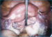 Abb. 3: Utero-tubal junction