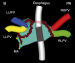 Abb. 2: Vorhof - Pulmonalvene