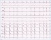 Abb. 2: EKG
