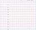 Abb. 3: EKG - Lysetherapie