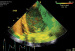 Aktuelles Bild - Abb. 17: Tissue Synchronization Imaging (TSI)