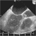 Abb. 9: Transthorakales Echo