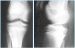 Abb. 9: Osteochondrosis