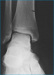 Abb. 10: Osteochondrosis