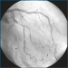 Abb. 2: LAD-Stent