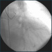 Abb. 3: Stent-Leeraufnahme