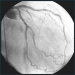Abb. 4: LAD-Stent