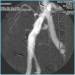 Aktuelles Bild - Abb. 3: Angiographie - A. iliaca communis