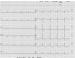 Aktuelles Bild - Abb. 1: QT-Verlngerung