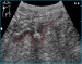 Aktuelles Bild - Abb. 1: Sonographische Darstellung eines Divertikels im Colon sigmoideum