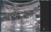 Abb. 2: Sonographie einer entzndlich verdickten Darmwand