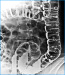 Abb. 3: Kolonkontrasteinlauf mit Darstellung der Divertikel im Colon sigmoideum und ascendens