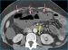 Abb. 1A: CT-Bild in axialer Schichtfhrung