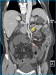 Abb. 1B: 3D-Rekonstruktion der CT