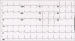 Abb. 10: EKG