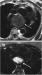 Abb. 6a-b: Trubospinechosequenz