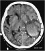 Abb. 1: Diffuse Blutung