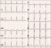 Abb. 1: Supraventrikulre Tachykardie