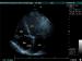 Abb. 2: Pericarditis constrictiva